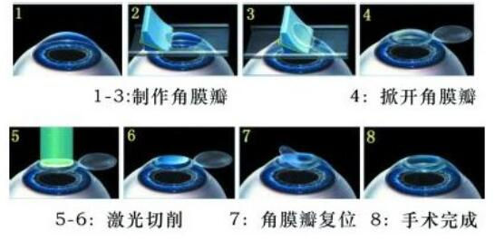 準(zhǔn)分子激光手術(shù)到底是怎么治 愈你的眼睛的？