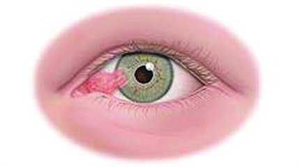 眼睛上會有一塊肉，影響視力怎么辦？