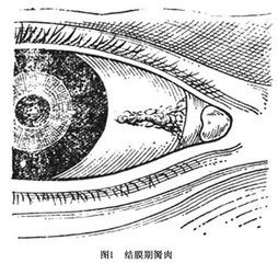 黑眼睛前面多長出一塊白肉怎么辦？