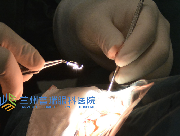 蘭州眼科醫(yī)院 白內(nèi)障手術(shù)后注意事項