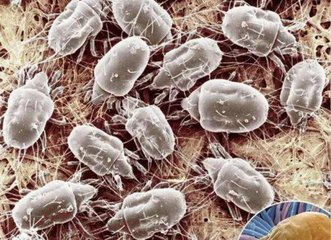 個(gè)人衛(wèi)生差，螨蟲(chóng)會(huì)寄宿眼部得蠕形螨瞼緣炎