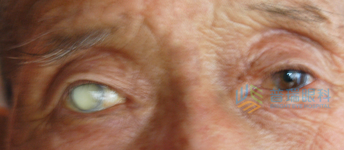 你知道嗎？白內(nèi)障眼病不會瞎還會引發(fā)其他眼病
