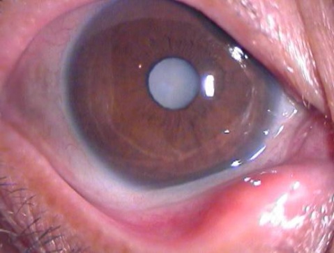 年輕就不會得白內(nèi)障，沒事不會瞎？