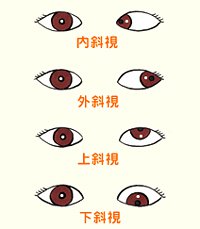 看看兒童斜視眼病怎么預(yù)防？