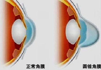 圓錐角膜，哪種角膜移植術(shù)好？