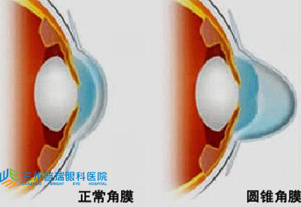 圓錐角膜怎樣？