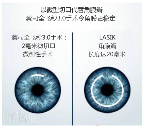 近視手術有哪幾種？你適合那種快看看